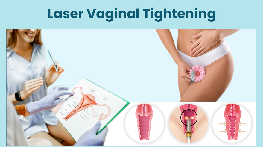 Vaginal Tightening Treatment