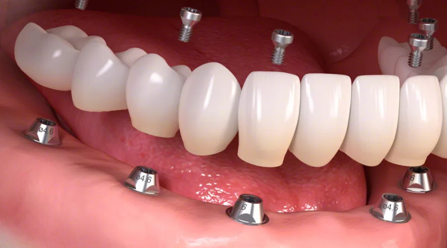 all on 6 dental implants in Encino